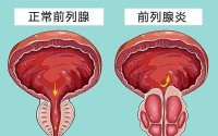 前列腺炎有什么危害？牡蛎肽对改善前列腺功能有什么作用？