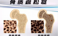 骨质疏松是什么原因？骨质疏松对健康的全面影响