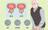 槲皮素在前列腺癌治疗中的作用