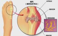 降尿酸药食同源食物排行榜——菊在降尿酸中的应用