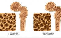 牦牛三髓粉对骨质疏松
