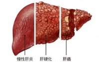 干细胞在治疗肝硬化方面的应用实例
