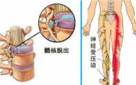 干细胞疗法在治疗腰椎间盘突出中的应用，干细胞疗法的费用