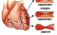 地龙蛋白肽可以防治冠状动脉粥样硬化吗？地龙蛋白对心血管病有什么作用？