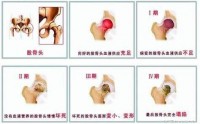 股骨头坏死怎么治疗效果好？干细胞疗法对股骨头坏死有什么作用？