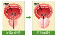 前列腺增生的症装有哪些？前列腺增生适合吃牡蛎肽小分子肽吗？
