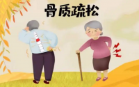 骨肽螯合钙与骨质疏松