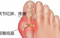 痛风不算病？！痛风起来要人命！