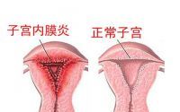 引发子宫内膜炎的因素有哪些？如何预防子宫内膜炎？肽对妇科炎症的调理作用！