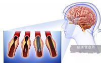 脑血栓可以吃地龙蛋白吗？地龙蛋白能溶解血栓吗？