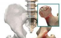 干细胞治疗股骨头坏死有什么作用？