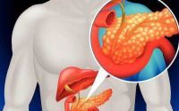胰腺炎是什么原因引起的？如何预防胰腺炎的发生？