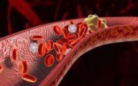 血栓是怎么形成的？什么方法能够防治血栓？纳豆激酶溶解血栓效果好吗？