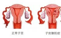 女人腺肌症怎么引起的？如何预防子宫腺肌症？