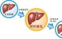 干细胞可以治疗肝硬化吗？干细胞治疗肝硬化的作用原理！