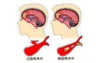 引起脑溢血的原因是什么？脑出血的人可以吃小分子肽吗？