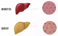 干细胞疗法与肝脏疾病，脐带血干细胞在修复肝脏中的应用