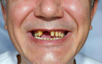 老年人牙齿为什么会变长？有什么危险吗？