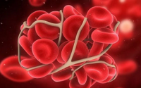纳豆激酶地龙蛋白粉为什么能预防脑血栓？