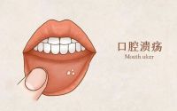 口腔溃疡是什么原因引起的,口腔溃疡怎么缓解?