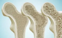 骨胶原蛋白营养与改善骨质疏松