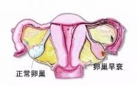 卵巢早衰怎么造成的,卵巢早衰的症状有哪些?