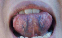 舌下青筋对健康的影响大吗?