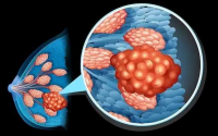 免疫疗法在治疗乳腺癌中的应用