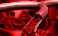 地龙蛋白肽溶解大小血栓,清洗血管里的头号敌人“血垢”
