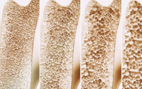 干细胞可以再生骨骼用于治疗骨质疏松效果显著