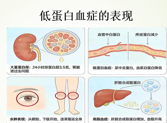 低蛋白血症.png