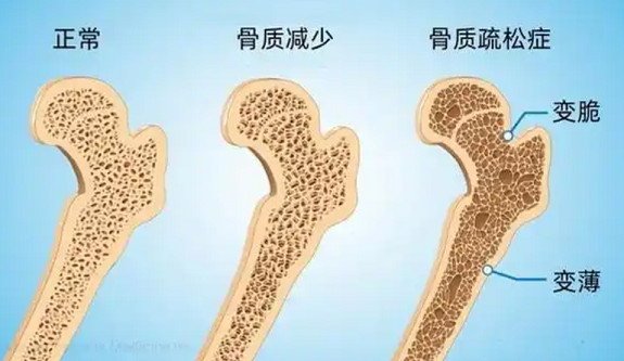 骨质疏松症.png